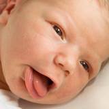 Treatment of lip & tongue ties in young babies